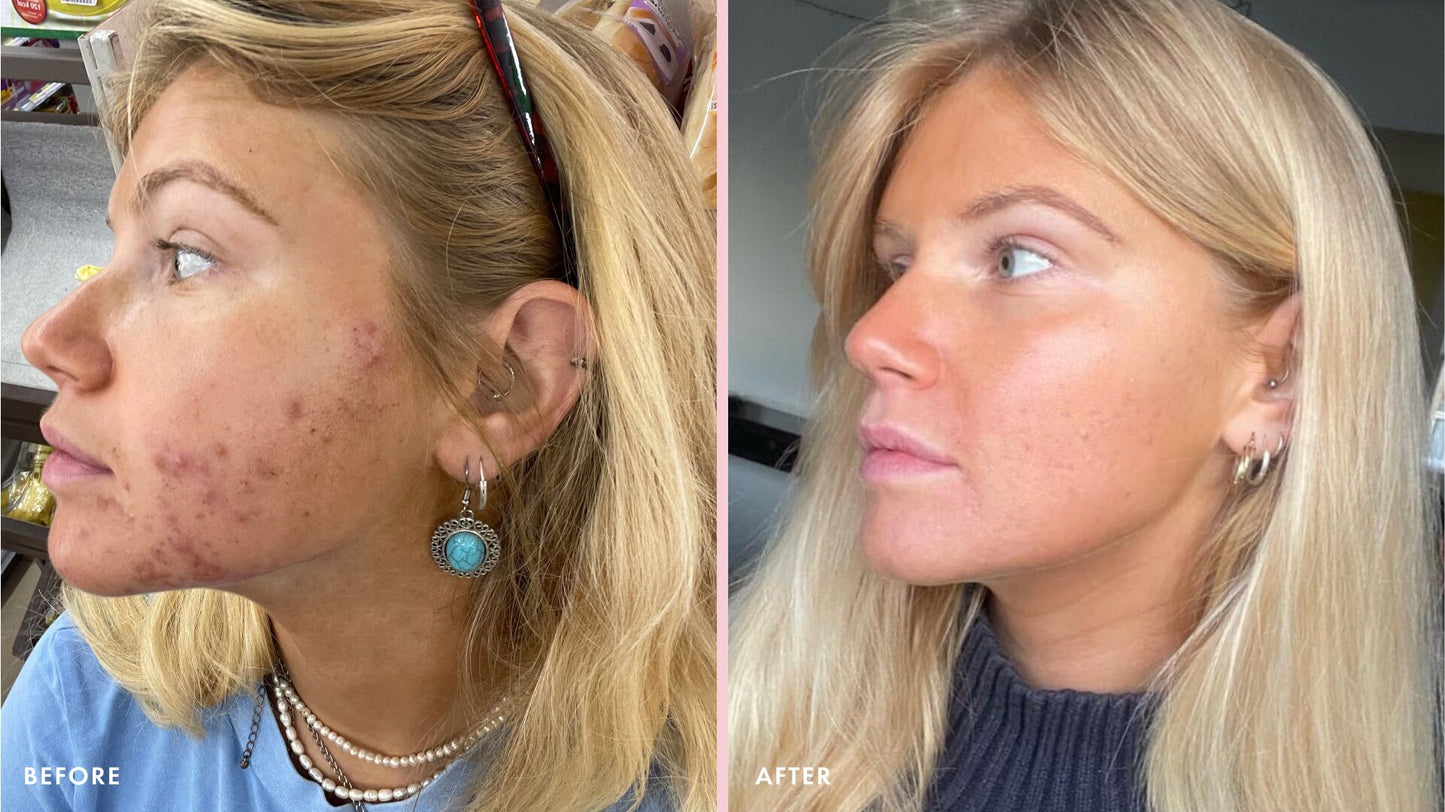 Osei Acne Support